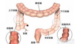 直肠炎的症状及病因